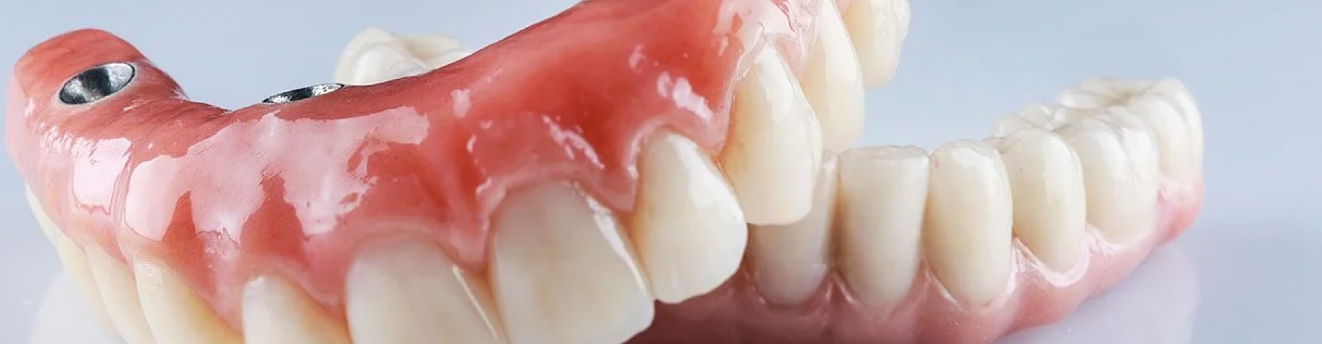 Lower and upper implant-retained dentures leaning on each other.